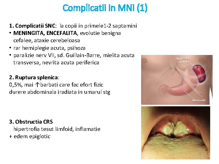 Complicatii in MNI (1) 1. Complicatii SNC: la copii in primele 1 -2 saptamini