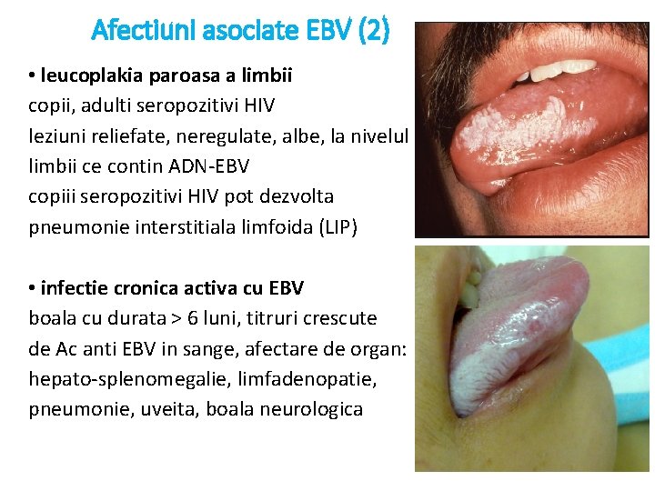Afectiuni asociate EBV (2) • leucoplakia paroasa a limbii copii, adulti seropozitivi HIV leziuni