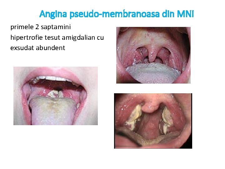 Angina pseudo-membranoasa din MNI primele 2 saptamini hipertrofie tesut amigdalian cu exsudat abundent 