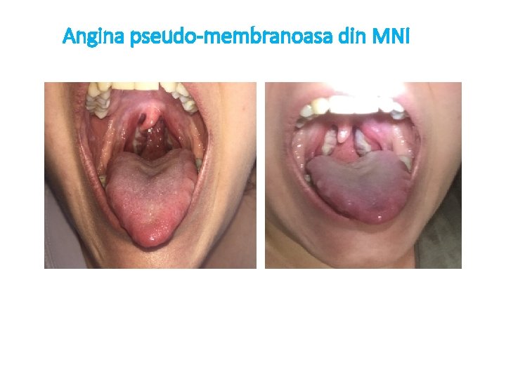 Angina pseudo-membranoasa din MNI 