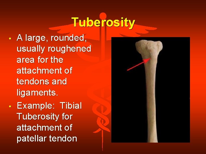 Tuberosity • • A large, rounded, usually roughened area for the attachment of tendons