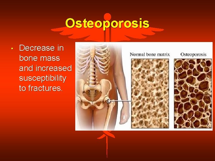 Osteoporosis • Decrease in bone mass and increased susceptibility to fractures. 