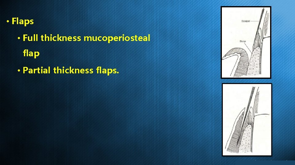  • Flaps • Full thickness mucoperiosteal flap • Partial thickness flaps. 