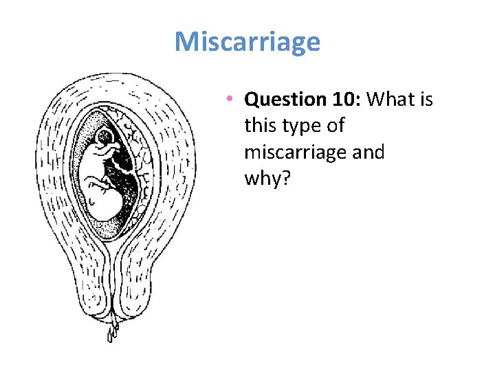 Miscarriage • Question 10: What is this type of miscarriage and why? 