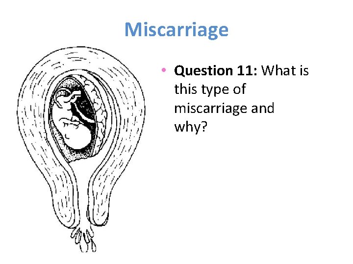 Miscarriage • Question 11: What is this type of miscarriage and why? 