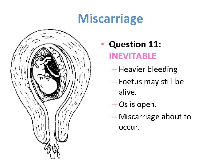 Miscarriage • Question 11: INEVITABLE – Heavier bleeding – Foetus may still be alive.
