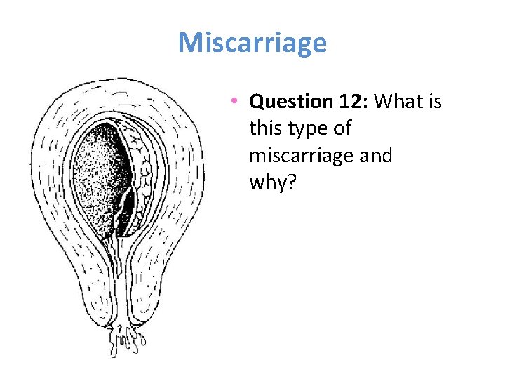 Miscarriage • Question 12: What is this type of miscarriage and why? 