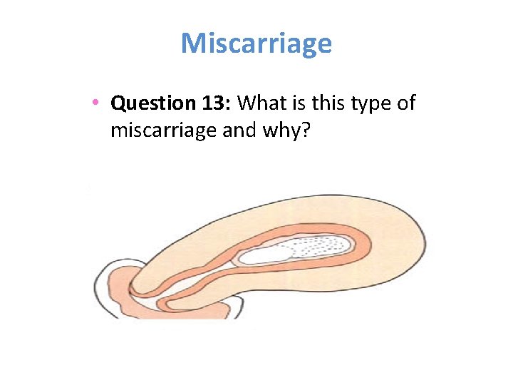 Miscarriage • Question 13: What is this type of miscarriage and why? 