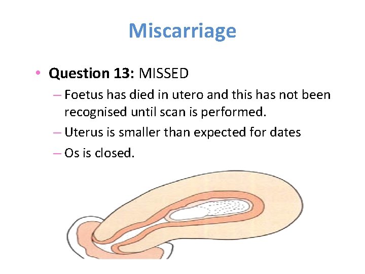 Miscarriage • Question 13: MISSED – Foetus has died in utero and this has