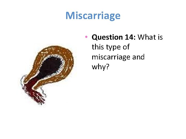 Miscarriage • Question 14: What is this type of miscarriage and why? 