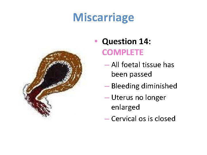 Miscarriage • Question 14: COMPLETE – All foetal tissue has been passed – Bleeding