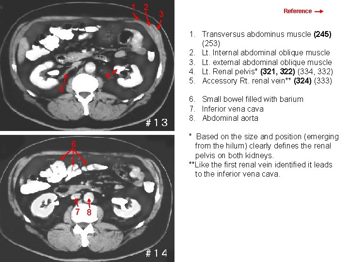 1 2 4 5 3 Images 13 & 14 Reference 1. Transversus abdominus muscle