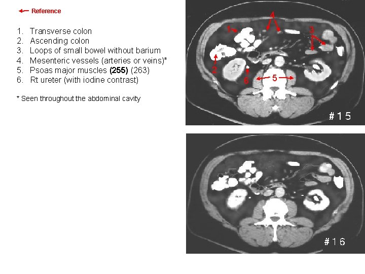 Reference 1. 2. 3. 4. 5. 6. 4 Transverse colon Ascending colon Loops of