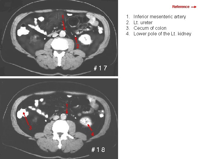 Reference 1. 2. 3. 4. 1 Inferior mesenteric artery Lt. ureter Cecum of colon