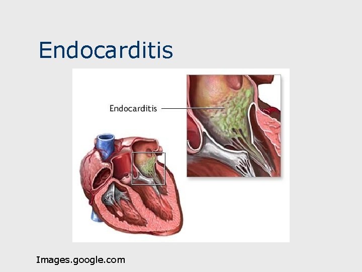 Endocarditis Images. google. com 