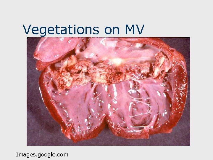 Vegetations on MV Images. google. com 