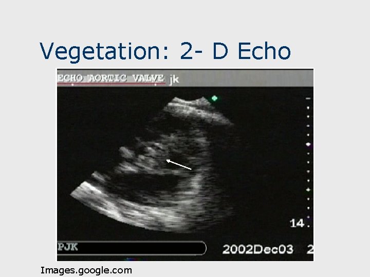 Vegetation: 2 - D Echo Images. google. com 