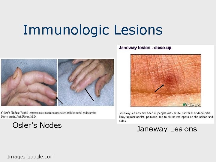 Immunologic Lesions Osler’s Nodes Images. google. com Janeway Lesions 