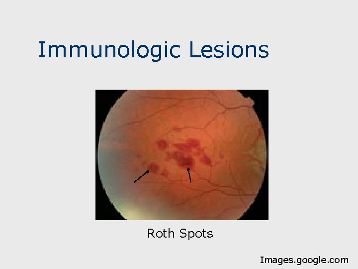 Immunologic Lesions Roth Spots Images. google. com 