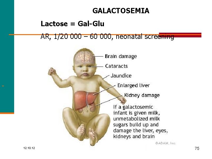 GALACTOSEMIA Lactose = Gal-Glu AR, 1/20 000 – 60 000, neonatal screening 12. 10.
