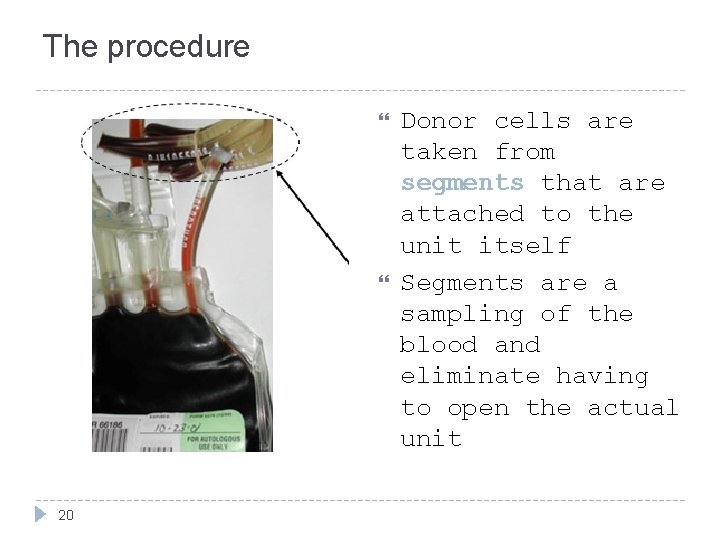 The procedure 20 Donor cells are taken from segments that are attached to the