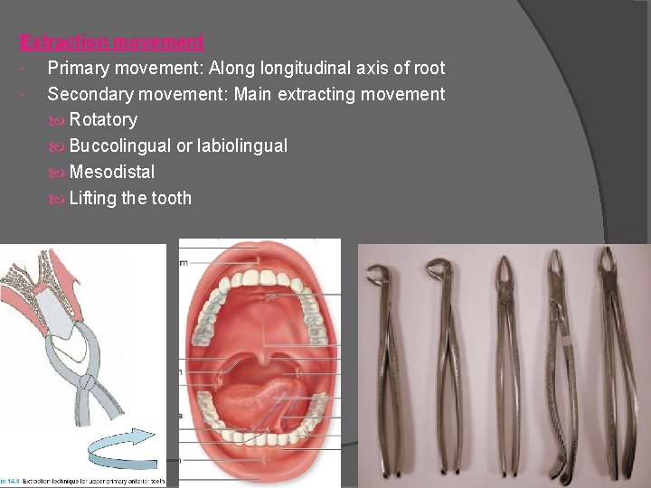 Extraction movement Primary movement: Alongitudinal axis of root Secondary movement: Main extracting movement Rotatory