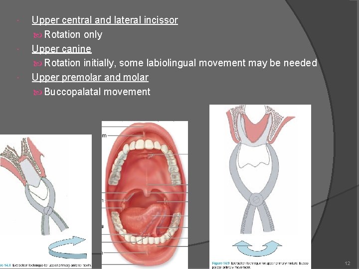  Upper central and lateral incissor Rotation only Upper canine Rotation initially, some labiolingual