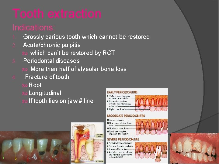 Tooth extraction Indications: Grossly carious tooth which cannot be restored 2. Acute/chronic pulpitis which