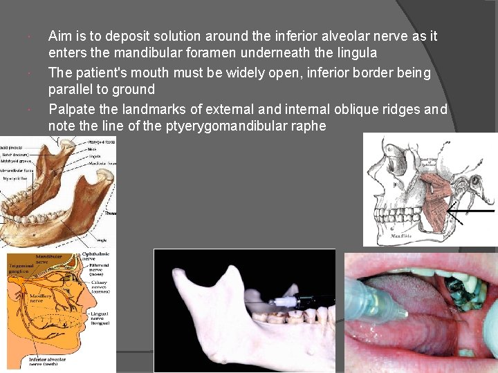  Aim is to deposit solution around the inferior alveolar nerve as it enters