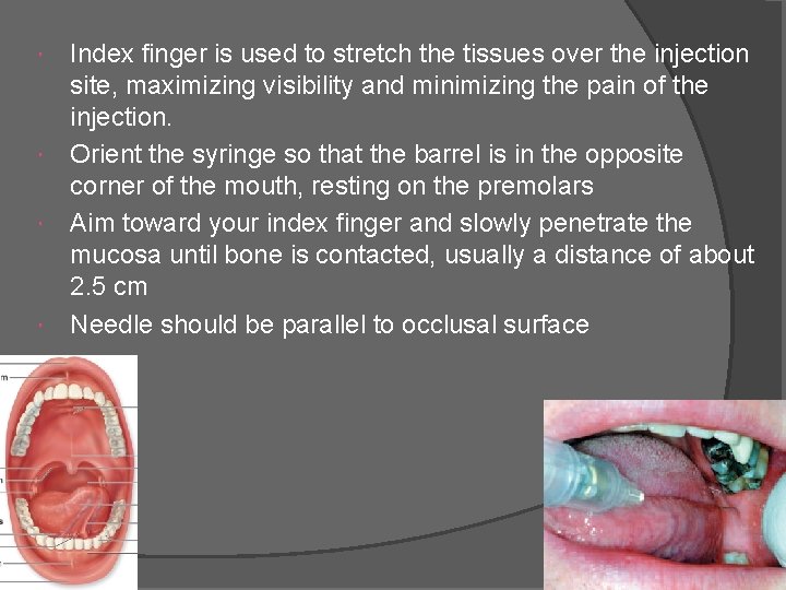 Index finger is used to stretch the tissues over the injection site, maximizing visibility