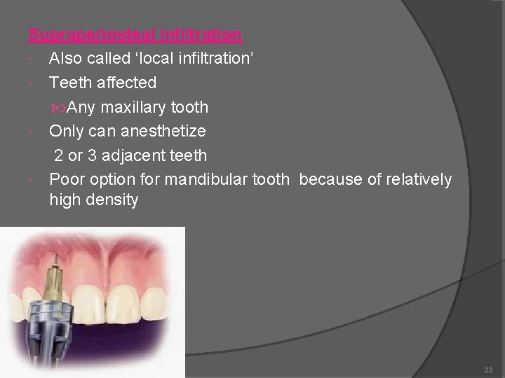 Supraperiosteal infiltration Also called ‘local infiltration’ Teeth affected Any maxillary tooth Only can anesthetize