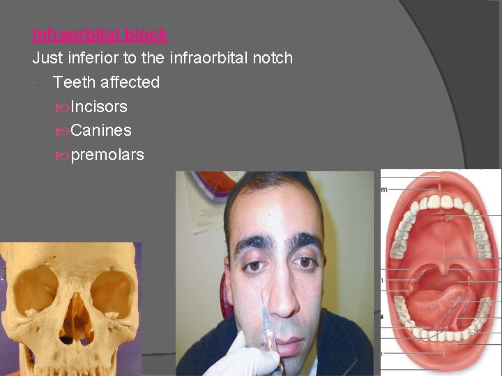 Infraorbital block Just inferior to the infraorbital notch Teeth affected Incisors Canines premolars 26