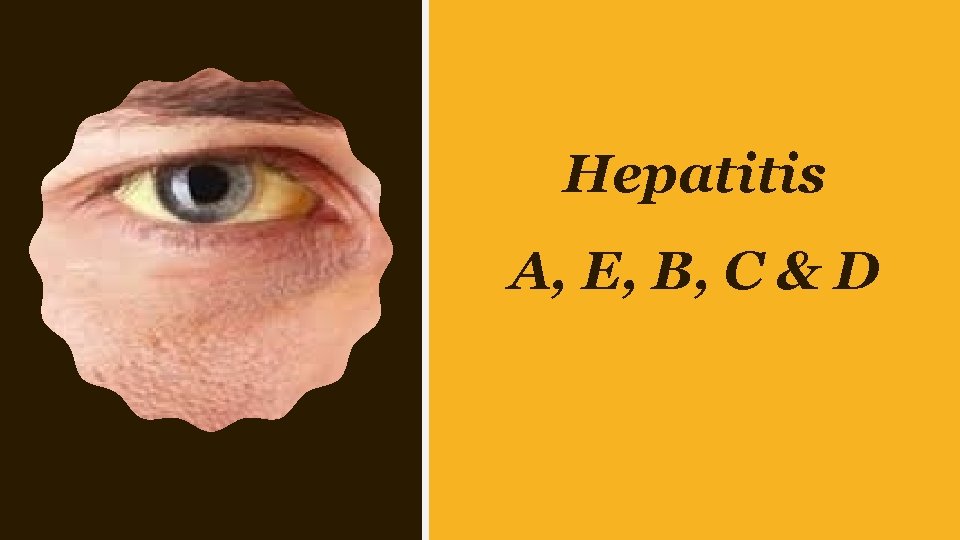 Hepatitis A, E, B, C & D 