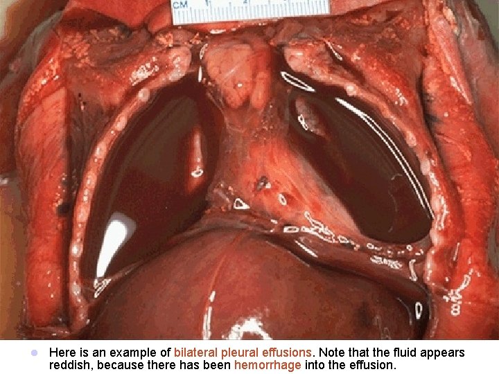 l Here is an example of bilateral pleural effusions. Note that the fluid appears