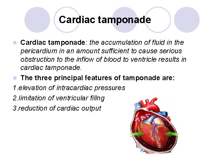 Cardiac tamponade: the accumulation of fluid in the pericardium in an amount sufficient to