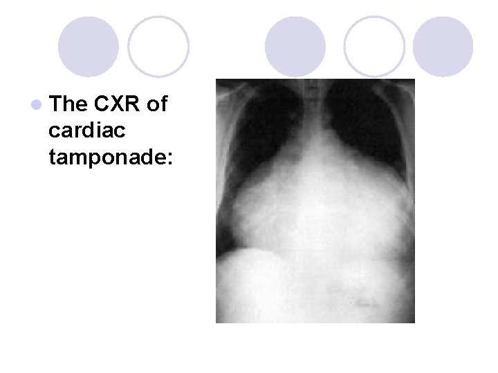 l The CXR of cardiac tamponade: 
