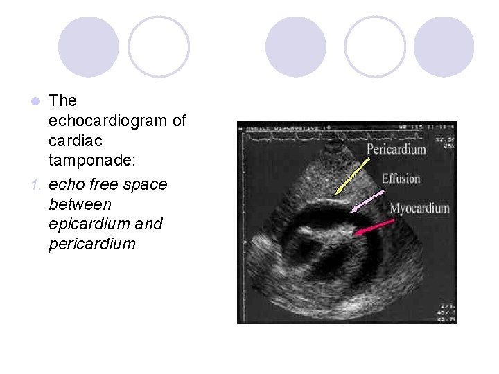 The echocardiogram of cardiac tamponade: 1. echo free space between epicardium and pericardium l