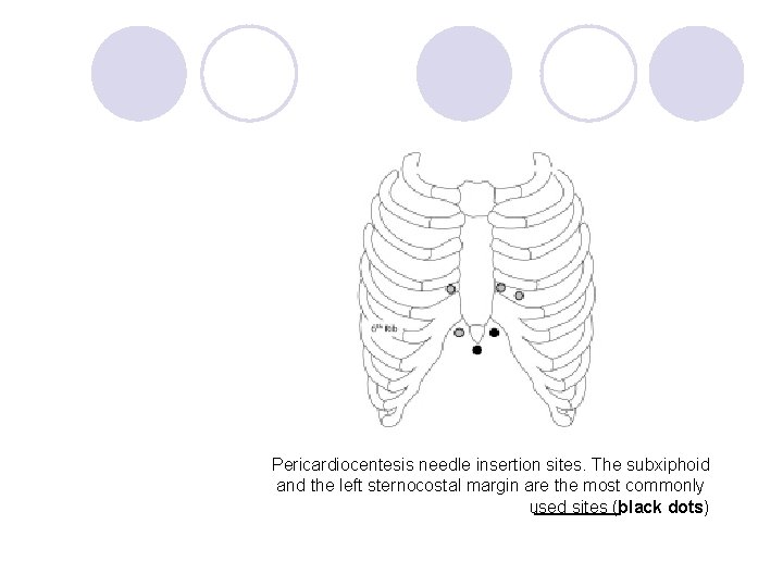 Pericardiocentesis needle insertion sites. The subxiphoid and the left sternocostal margin are the most