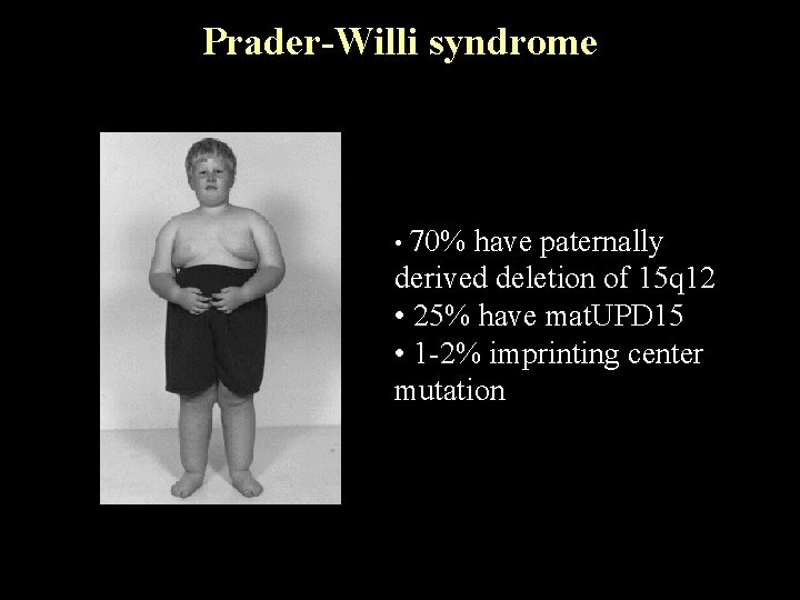 Prader-Willi syndrome • 70% have paternally derived deletion of 15 q 12 • 25%