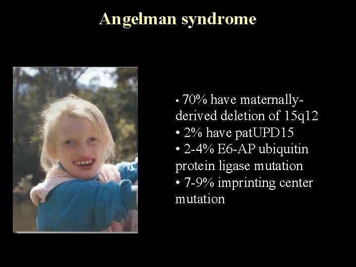 Angelman syndrome • 70% have maternallyderived deletion of 15 q 12 • 2% have