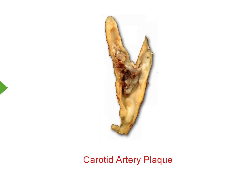 Carotid Artery Plaque 