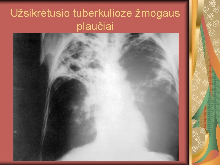 Užsikrėtusio tuberkulioze žmogaus plaučiai 