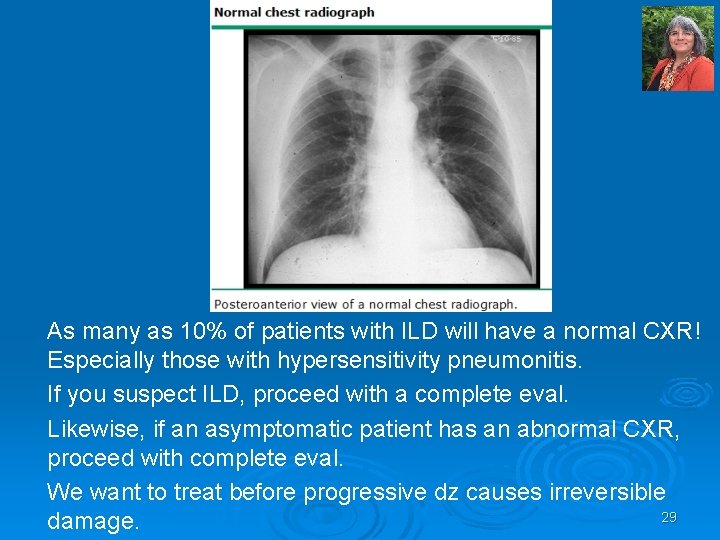As many as 10% of patients with ILD will have a normal CXR! Especially