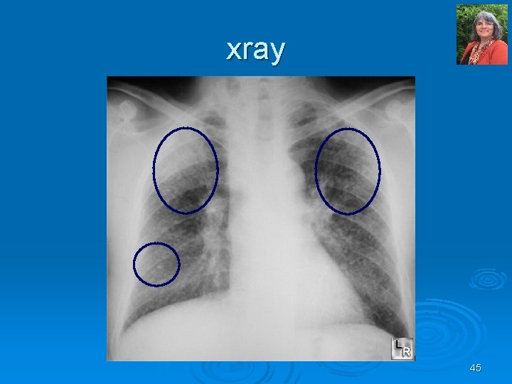 xray 45 