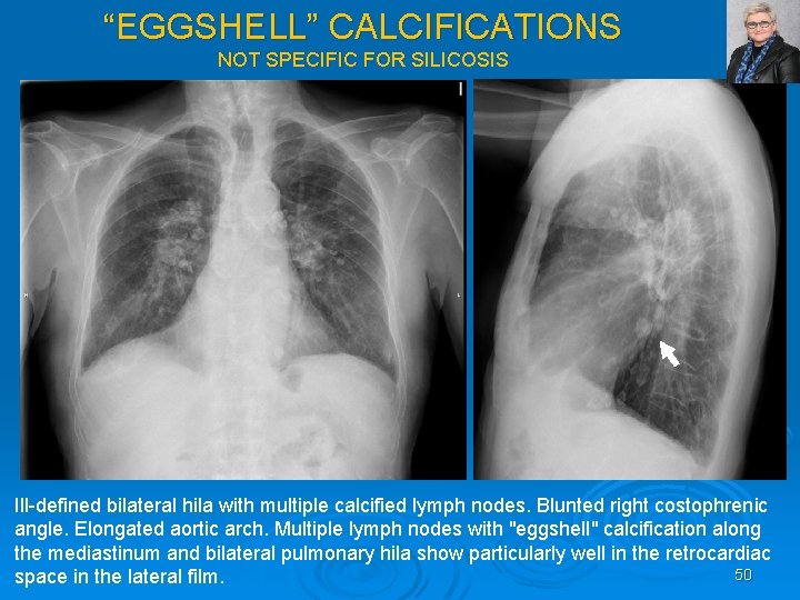 “EGGSHELL” CALCIFICATIONS NOT SPECIFIC FOR SILICOSIS Ill defined bilateral hila with multiple calcified lymph