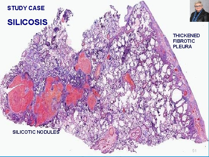 STUDY CASE SILICOSIS THICKENED FIBROTIC PLEURA SILICOTIC NODULES 51 