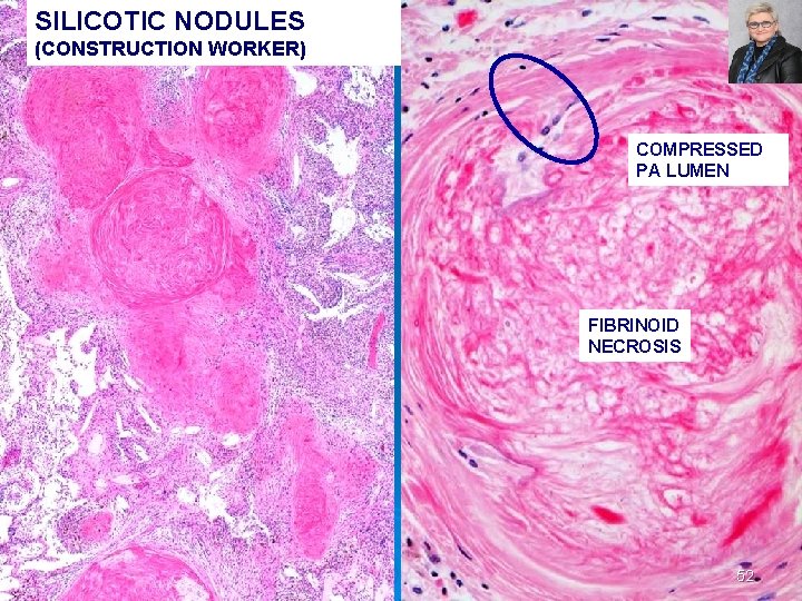 SILICOTIC NODULES (CONSTRUCTION WORKER) COMPRESSED PA LUMEN FIBRINOID NECROSIS 52 