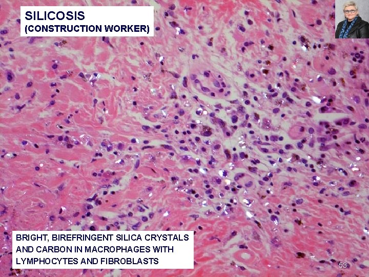 SILICOSIS (CONSTRUCTION WORKER) BRIGHT, BIREFRINGENT SILICA CRYSTALS AND CARBON IN MACROPHAGES WITH LYMPHOCYTES AND