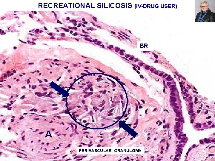 RECREATIONAL SILICOSIS (IV-DRUG USER) BR A PERIVASCULAR GRANULOMA 55 