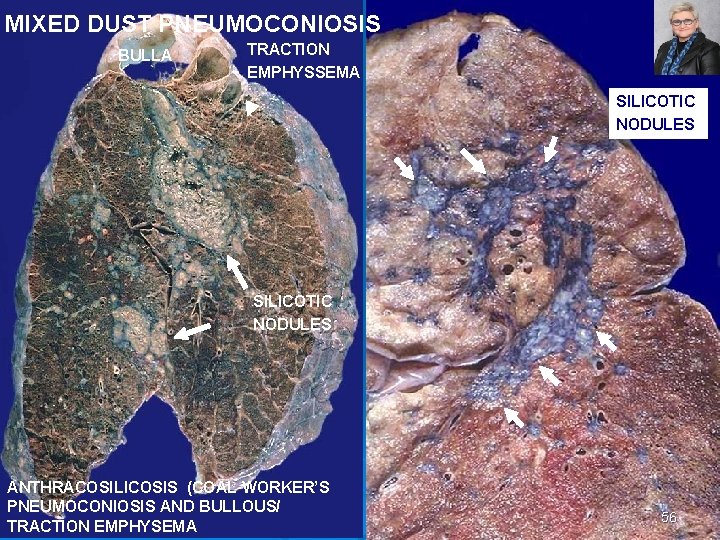 MIXED DUST PNEUMOCONIOSIS BULLA TRACTION EMPHYSSEMA SILICOTIC NODULES ANTHRACOSILICOSIS (COAL WORKER’S PNEUMOCONIOSIS AND BULLOUS/